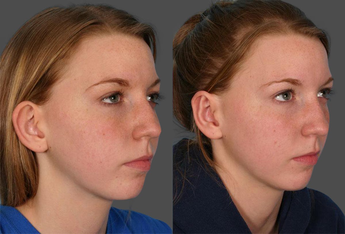 Ear Surgery (Otoplasty) Before & After Gallery - Patient 260357 - Image 2