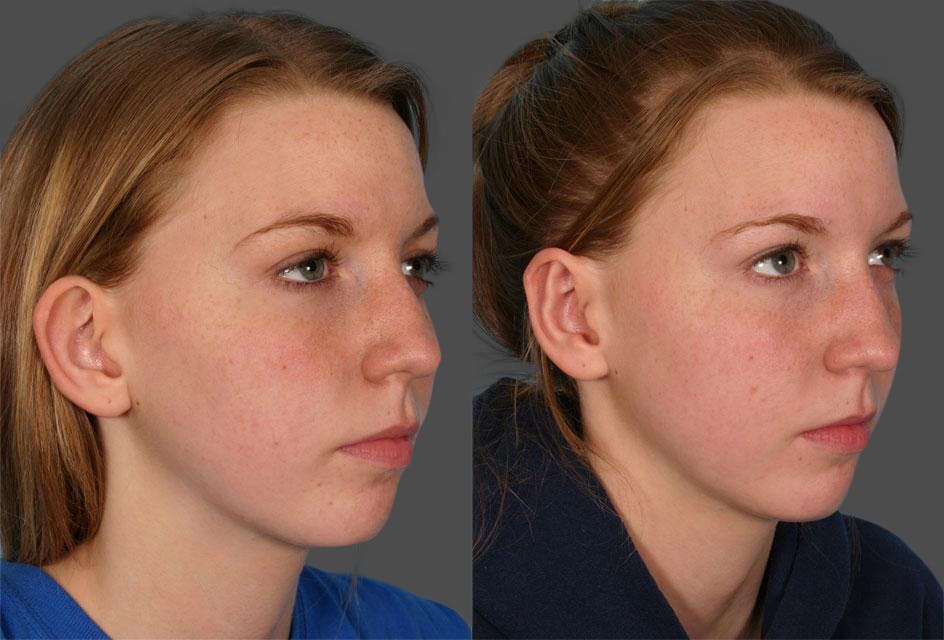 Ear Surgery (Otoplasty) Before & After Gallery - Patient 260357 - Image 2