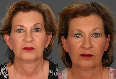 Ear Surgery (Otoplasty) Before & After Gallery - Patient 282136 - Image 1