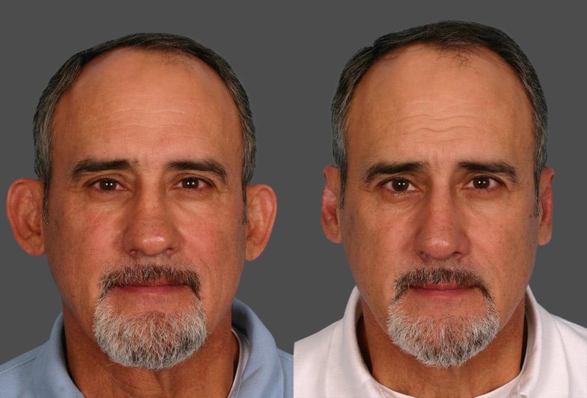 Ear Surgery (Otoplasty) Before & After Gallery - Patient 367756 - Image 1