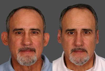 Ear Surgery (Otoplasty) Before & After Gallery - Patient 367756 - Image 1
