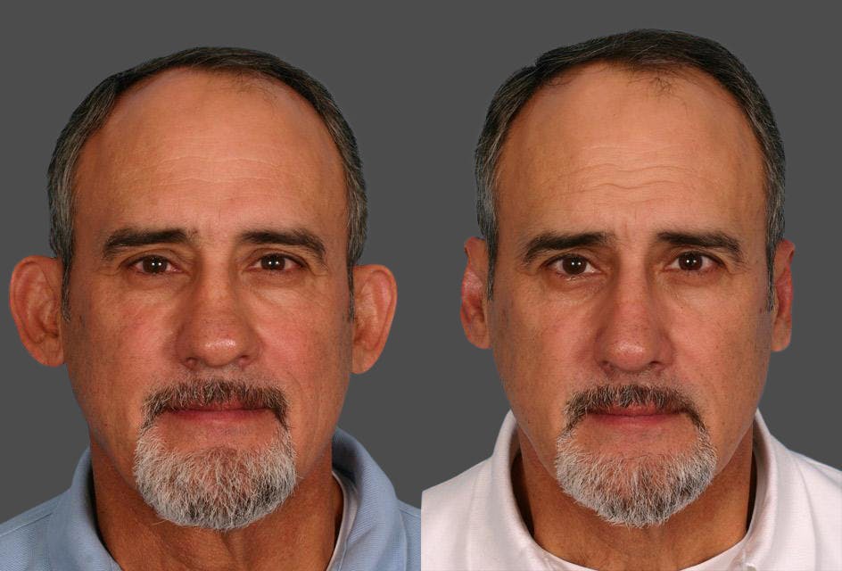 Ear Surgery (Otoplasty) Before & After Gallery - Patient 367756 - Image 1