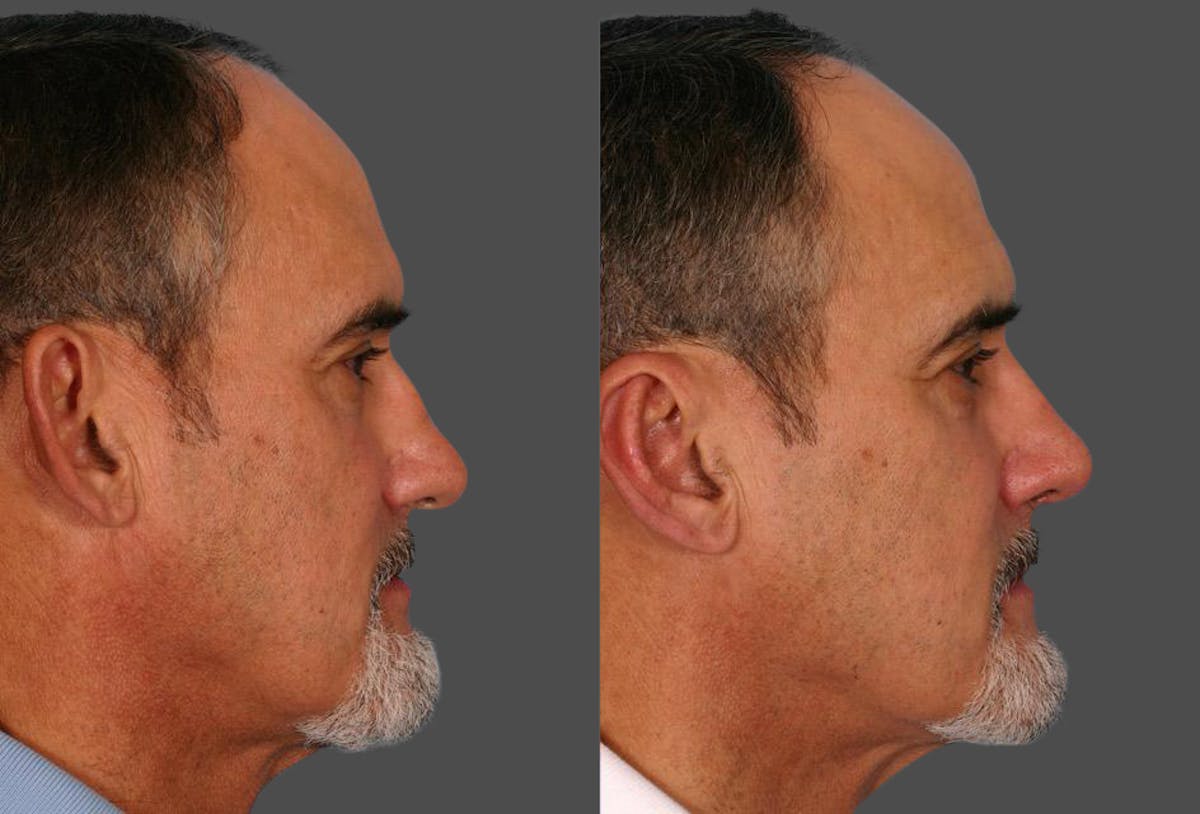 Ear Surgery (Otoplasty) Before & After Gallery - Patient 367756 - Image 2
