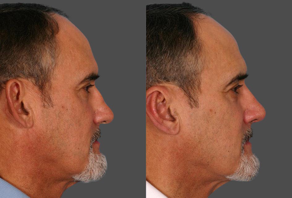 Ear Surgery (Otoplasty) Before & After Gallery - Patient 367756 - Image 2