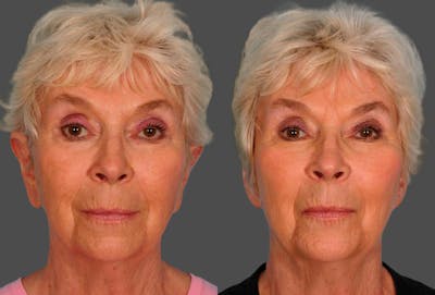 Ear Surgery (Otoplasty) Before & After Gallery - Patient 374305 - Image 1