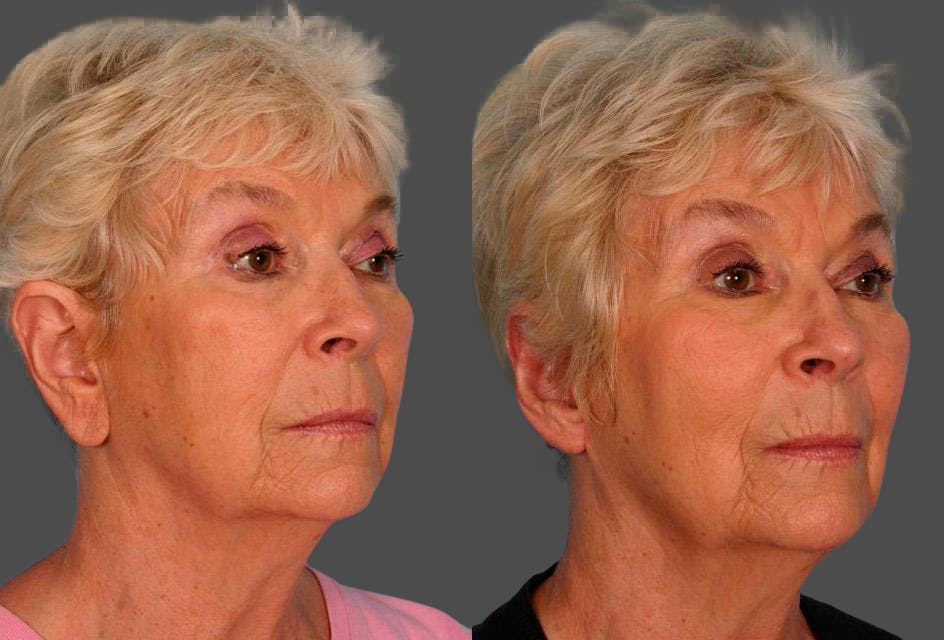 Ear Surgery (Otoplasty) Before & After Gallery - Patient 374305 - Image 2