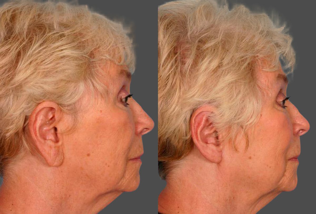 Ear Surgery (Otoplasty) Before & After Gallery - Patient 374305 - Image 3
