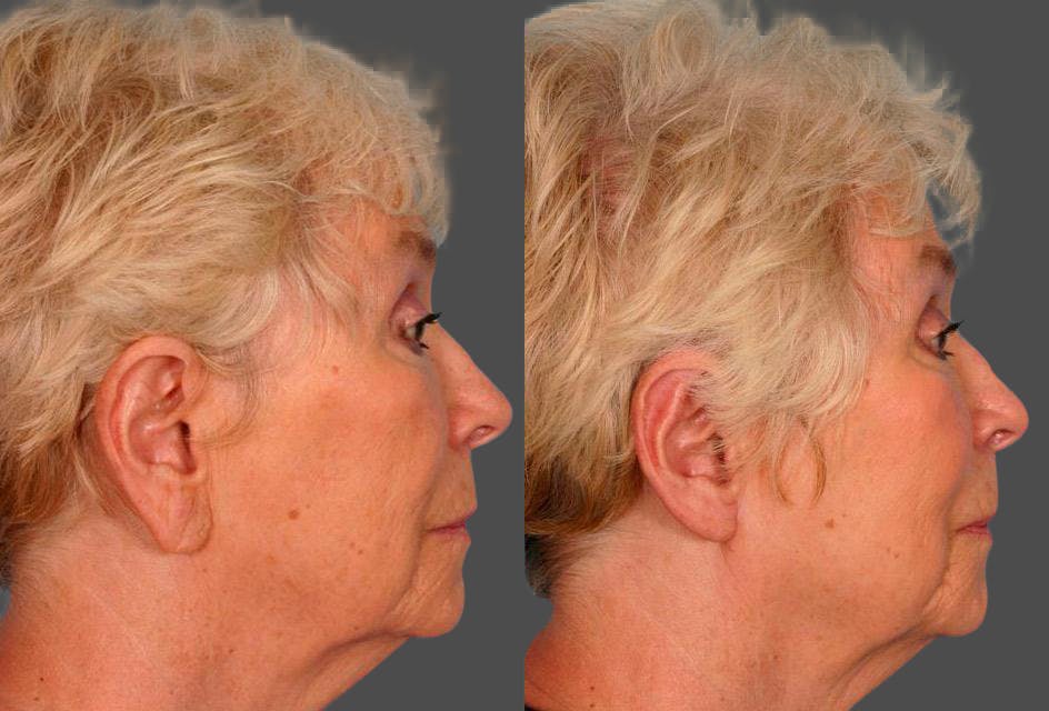 Ear Surgery (Otoplasty) Before & After Gallery - Patient 374305 - Image 3