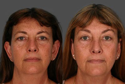Ear Surgery (Otoplasty) Before & After Gallery - Patient 375530 - Image 1