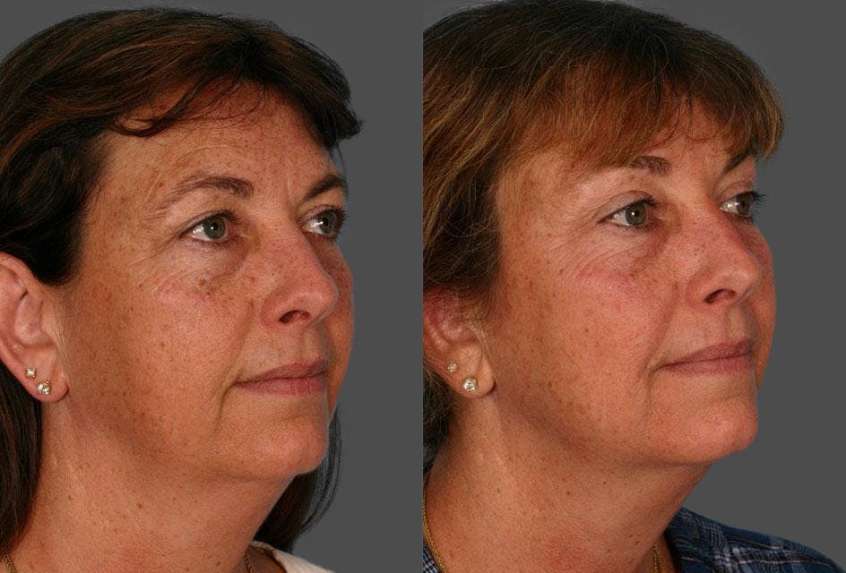 Ear Surgery (Otoplasty) Before & After Gallery - Patient 375530 - Image 2