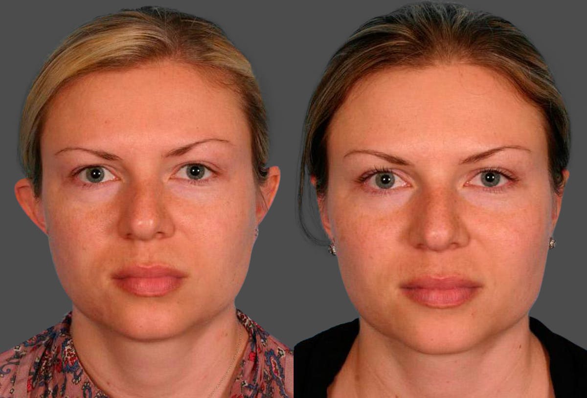 Ear Surgery (Otoplasty) Before & After Gallery - Patient 425990 - Image 1