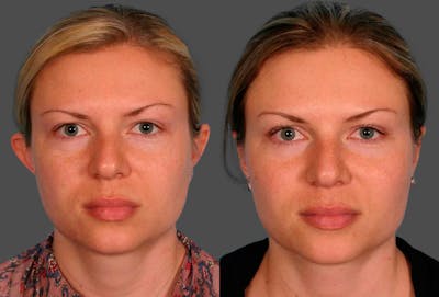 Ear Surgery (Otoplasty) Before & After Gallery - Patient 425990 - Image 1