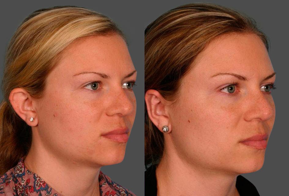 Ear Surgery (Otoplasty) Before & After Gallery - Patient 425990 - Image 2