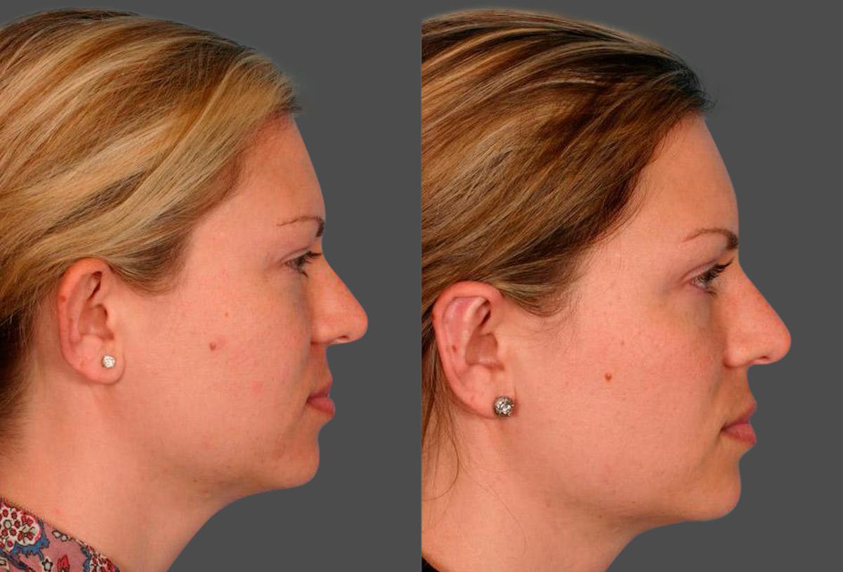Ear Surgery (Otoplasty) Before & After Gallery - Patient 425990 - Image 3