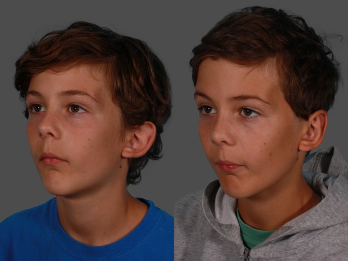 Ear Surgery (Otoplasty) Before & After Gallery - Patient 500391 - Image 2
