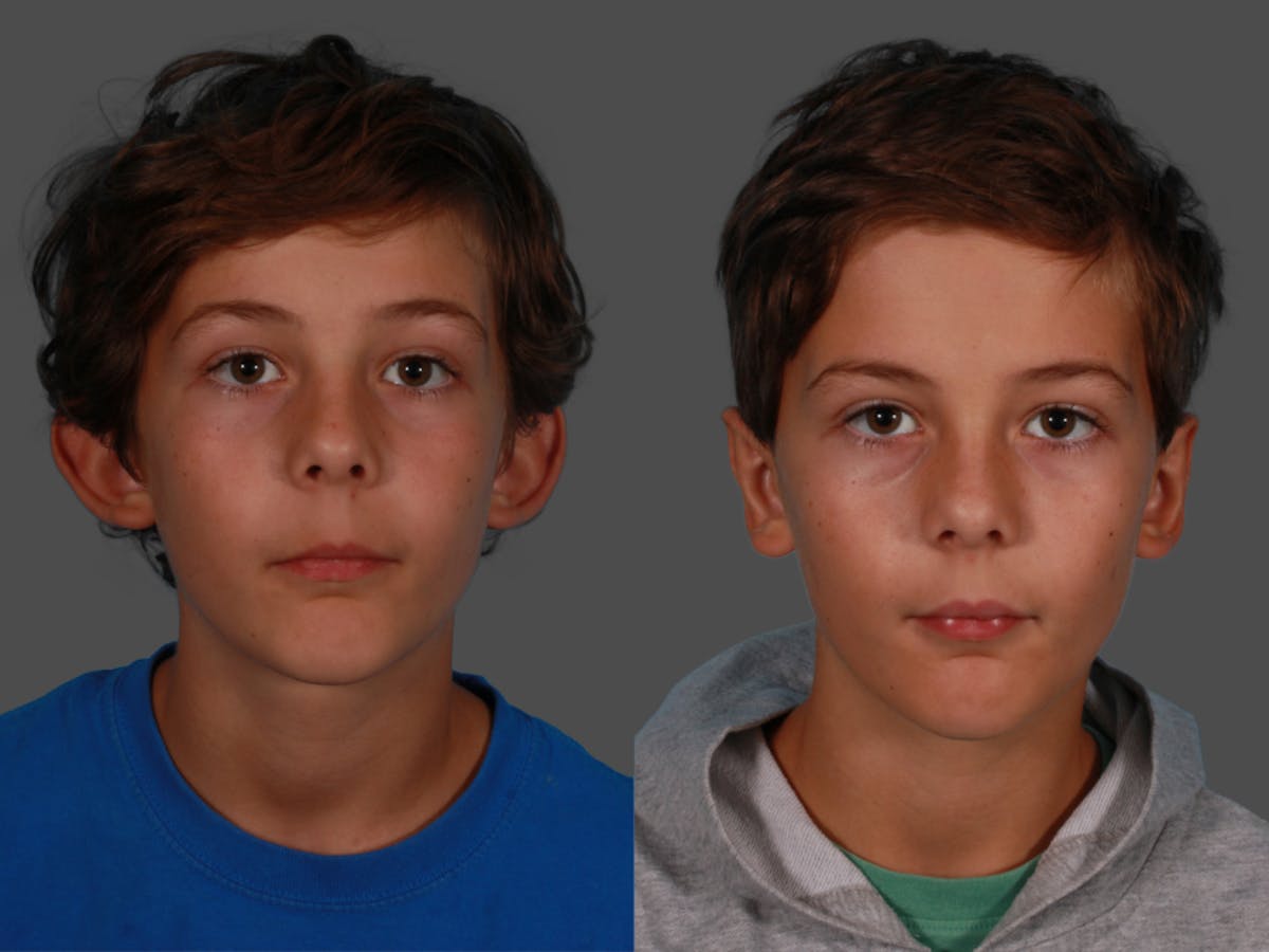 Ear Surgery (Otoplasty) Before & After Gallery - Patient 500391 - Image 1