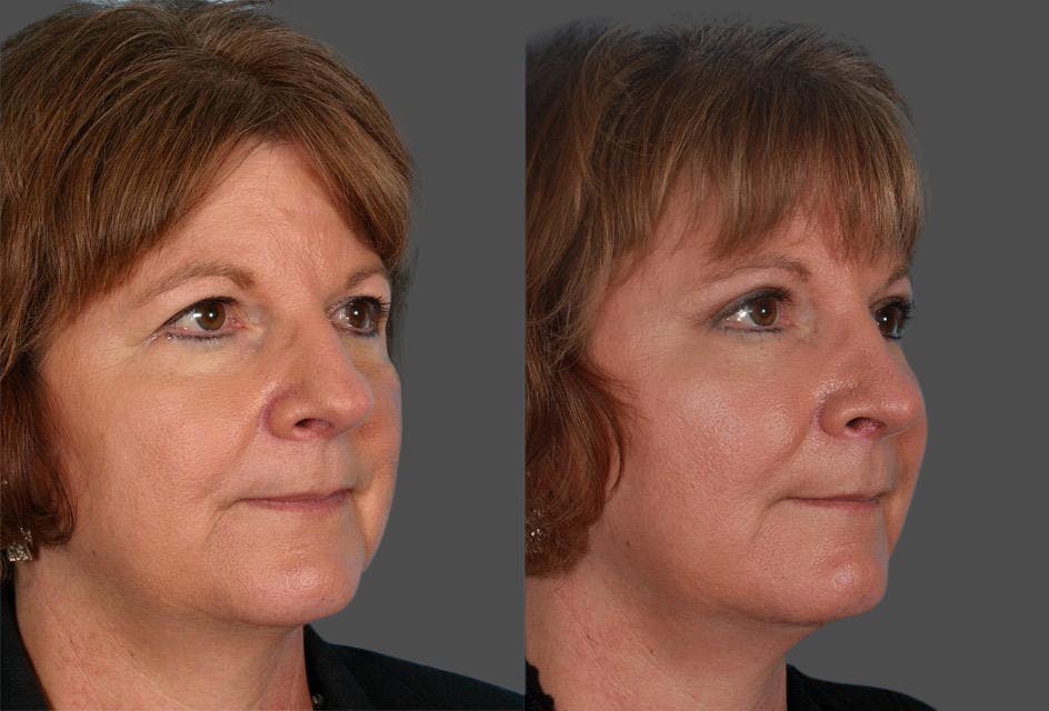 Endoscopic Brow Lift Before & After Gallery - Patient 123626 - Image 2