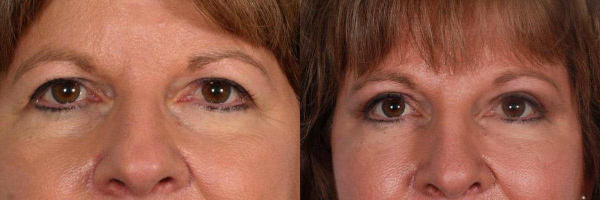 Endoscopic Brow Lift Before & After Gallery - Patient 123626 - Image 4