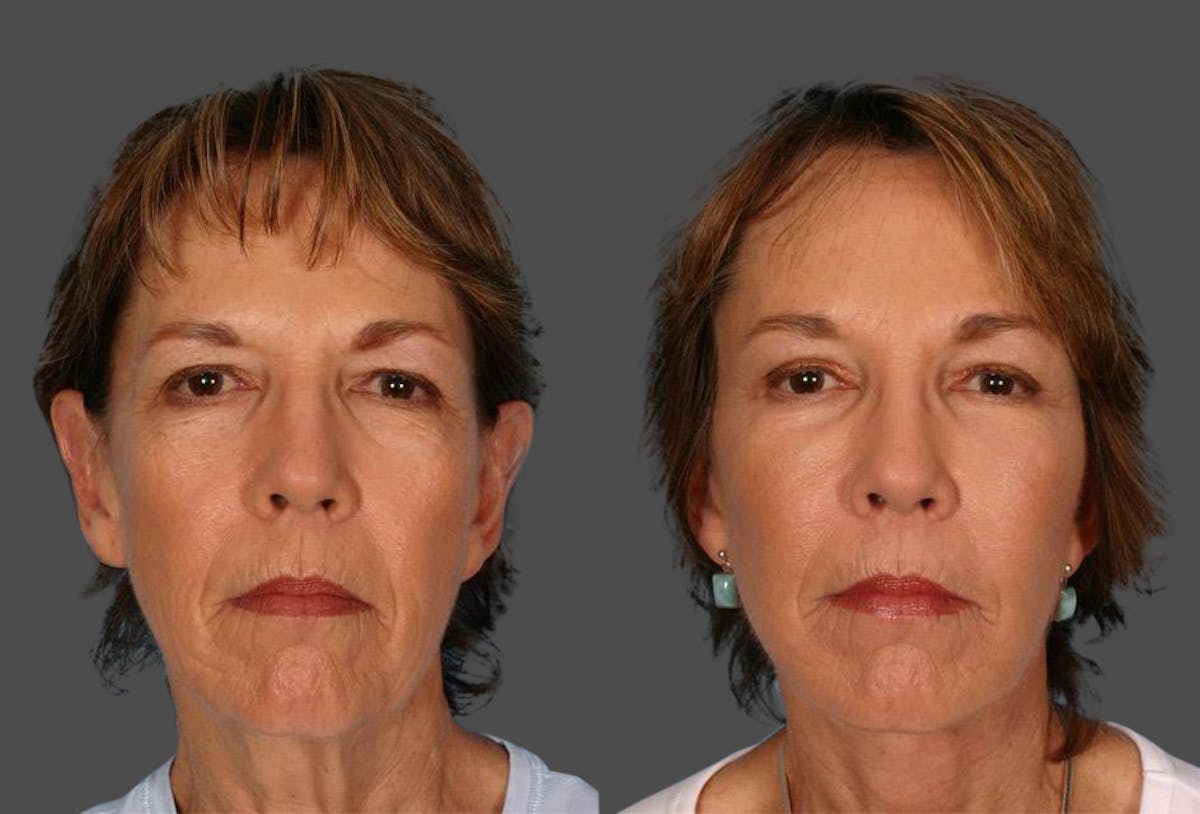 Endoscopic Brow Lift Before & After Gallery - Patient 136257 - Image 1