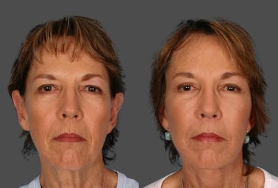 Endoscopic Brow Lift Before & After Gallery - Patient 136257 - Image 1