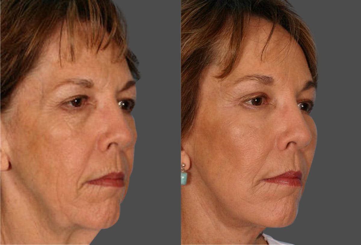 Endoscopic Brow Lift Before & After Gallery - Patient 136257 - Image 2