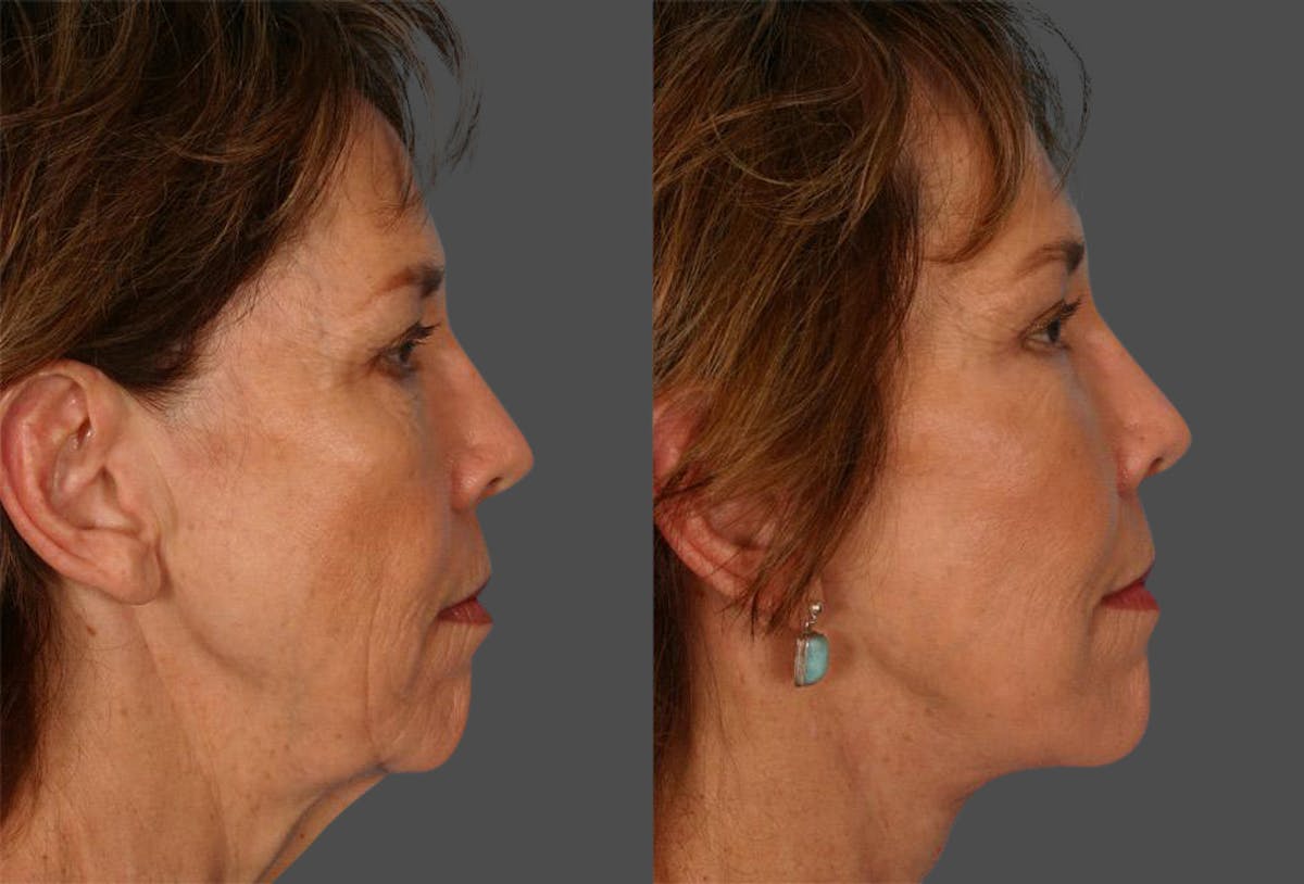 Endoscopic Brow Lift Before & After Gallery - Patient 136257 - Image 3