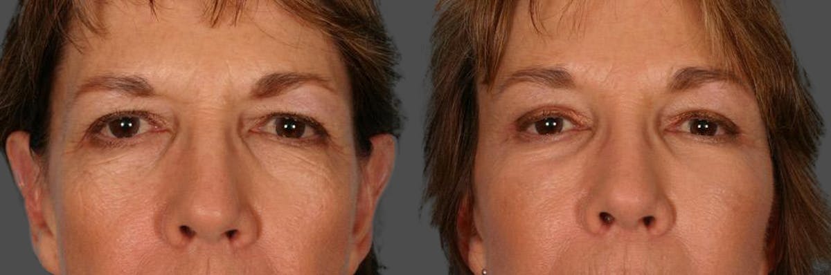 Endoscopic Brow Lift Before & After Gallery - Patient 136257 - Image 4