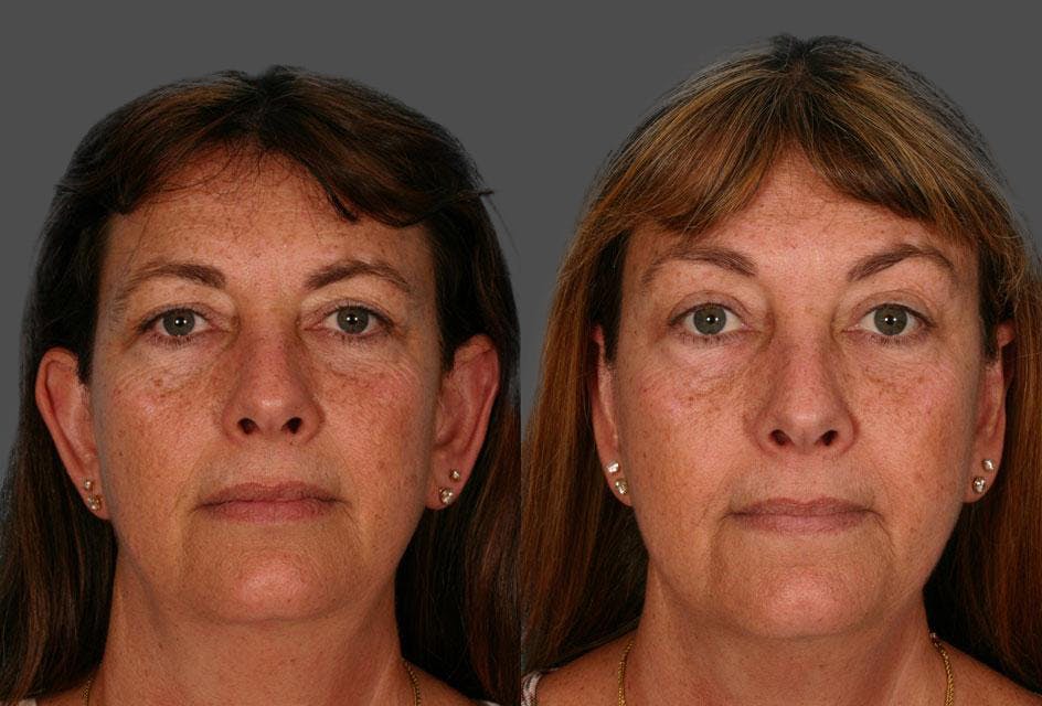 Endoscopic Brow Lift Before & After Gallery - Patient 165157 - Image 1