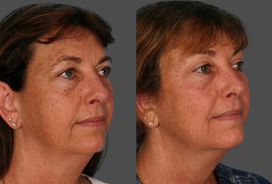 Endoscopic Brow Lift Before & After Gallery - Patient 165157 - Image 2