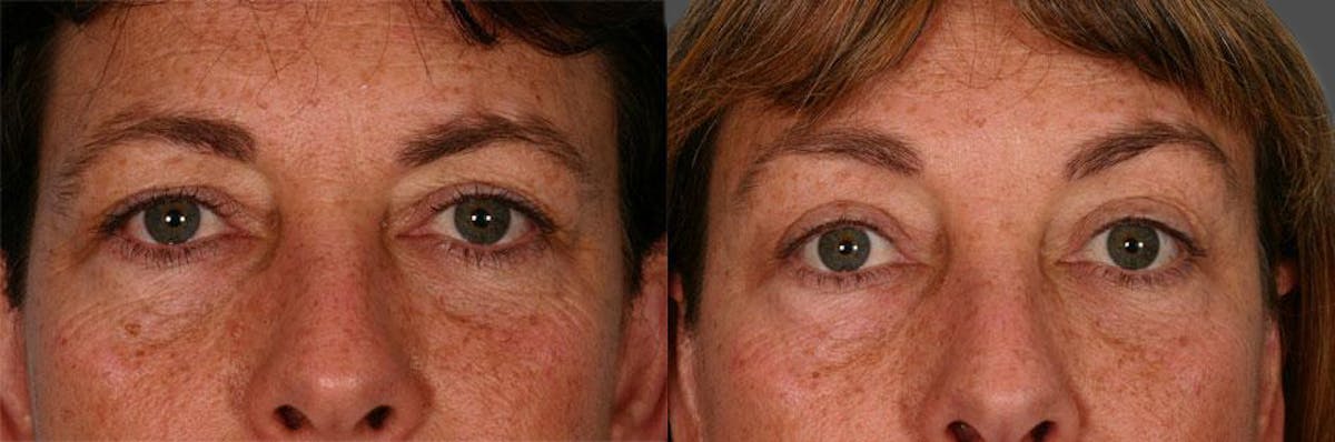 Endoscopic Brow Lift Before & After Gallery - Patient 165157 - Image 3