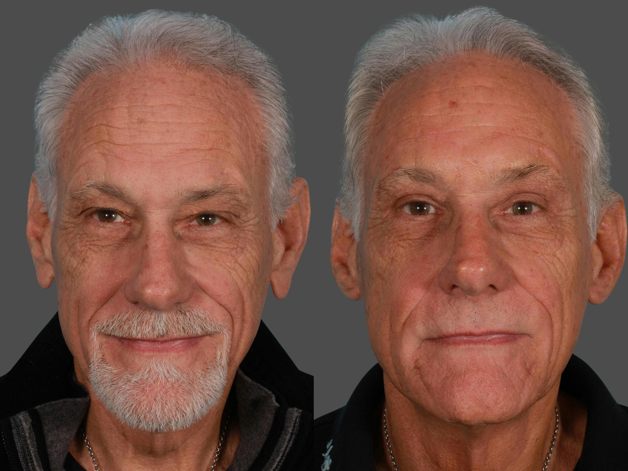 Endoscopic Brow Lift Before & After Gallery - Patient 216186 - Image 1