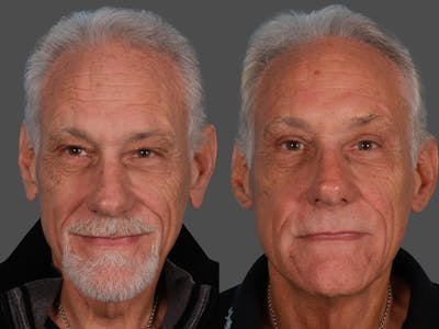 Endoscopic Brow Lift Before & After Gallery - Patient 216186 - Image 1