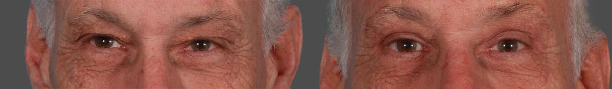Endoscopic Brow Lift Before & After Gallery - Patient 216186 - Image 2