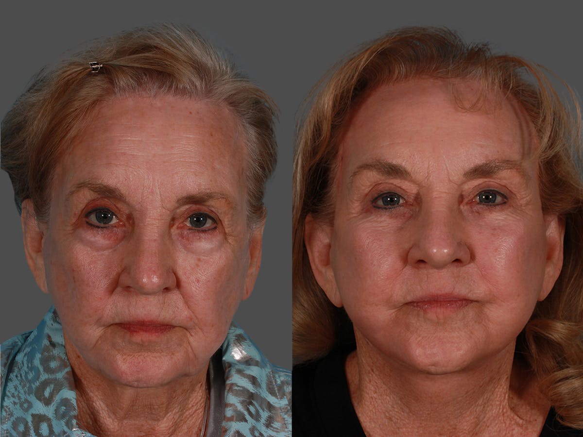 Endoscopic Brow Lift Before & After Gallery - Patient 220182 - Image 1