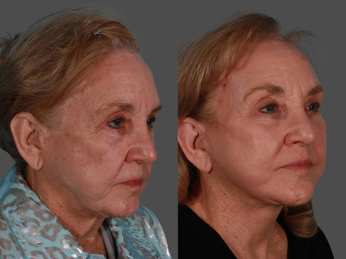 Endoscopic Brow Lift Before & After Gallery - Patient 220182 - Image 2