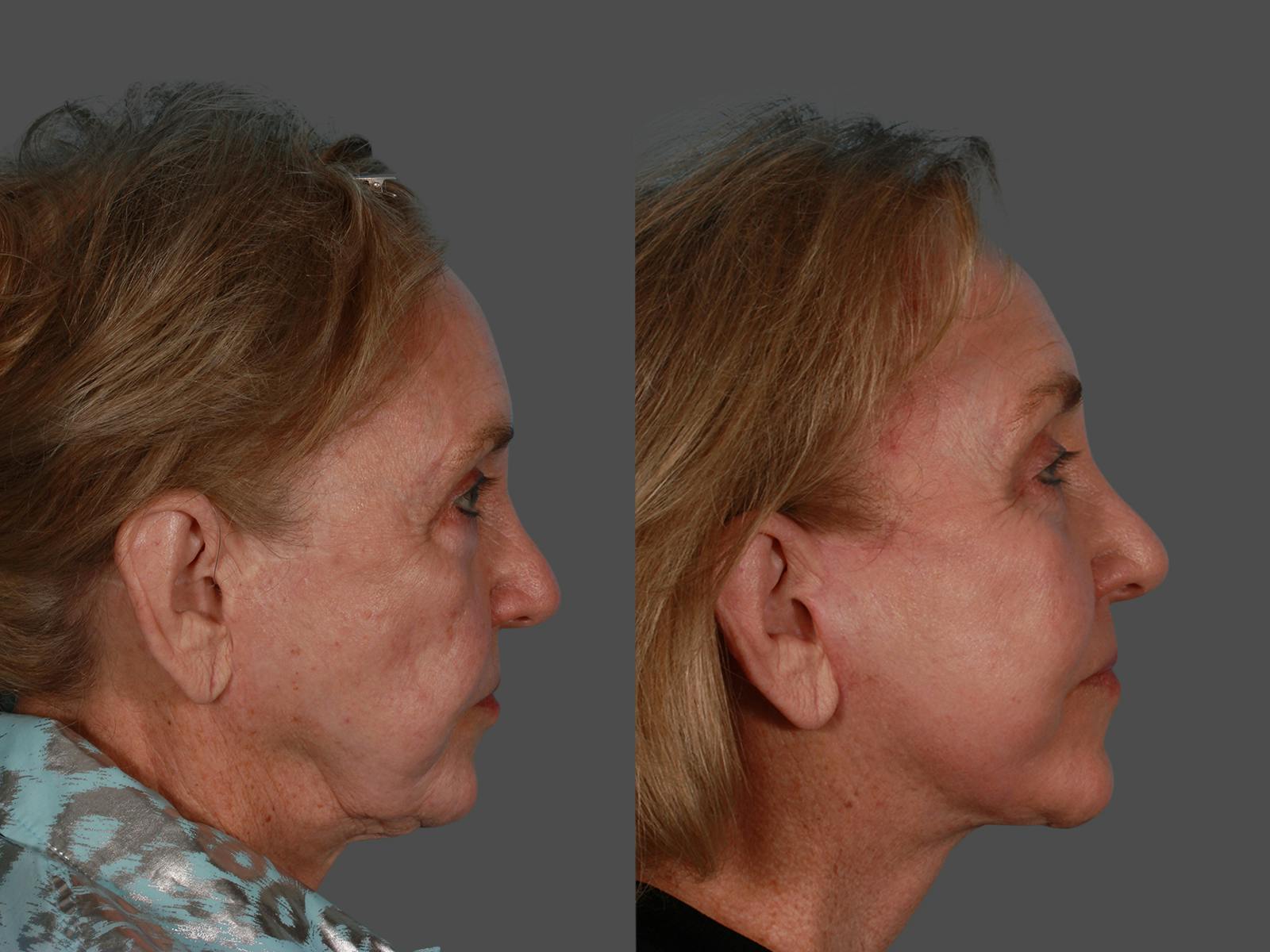 Endoscopic Brow Lift Before & After Gallery - Patient 220182 - Image 3