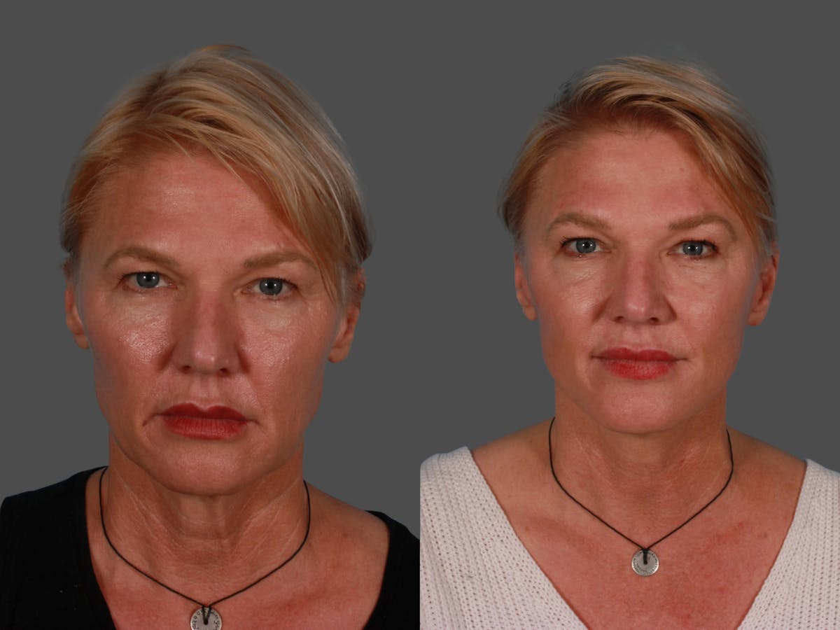 Endoscopic Brow Lift Before & After Gallery - Patient 268959 - Image 1