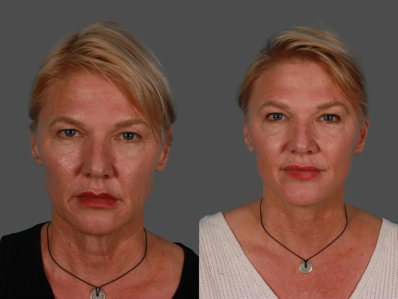 Endoscopic Brow Lift Before & After Gallery - Patient 268959 - Image 1
