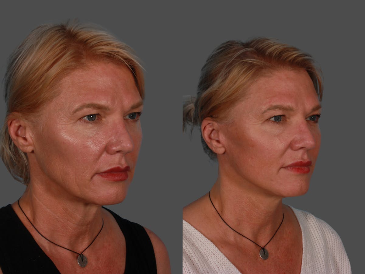 Endoscopic Brow Lift Before & After Gallery - Patient 268959 - Image 2