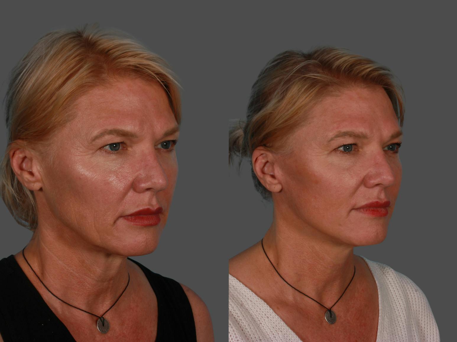 Endoscopic Brow Lift Before & After Gallery - Patient 268959 - Image 2