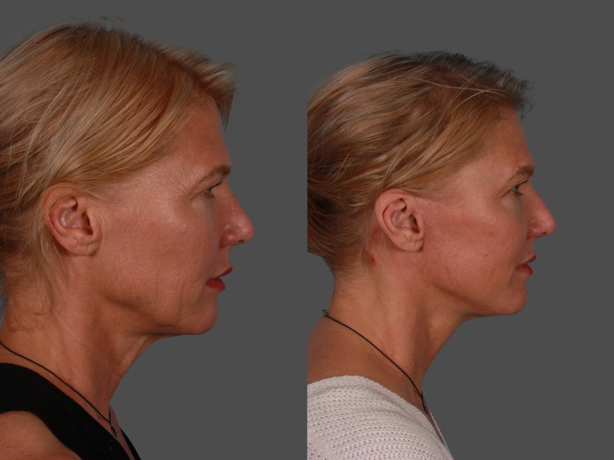 Endoscopic Brow Lift Before & After Gallery - Patient 268959 - Image 3