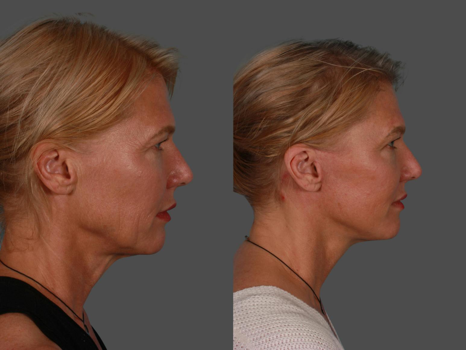 Endoscopic Brow Lift Before & After Gallery - Patient 268959 - Image 3