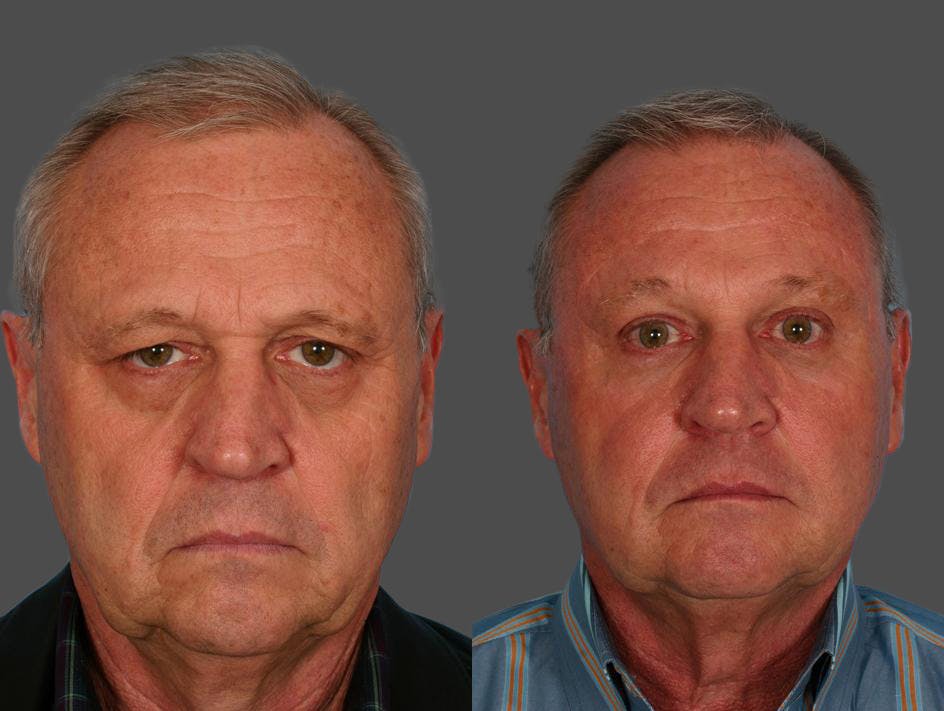 Endoscopic Brow Lift Before & After Gallery - Patient 270433 - Image 1