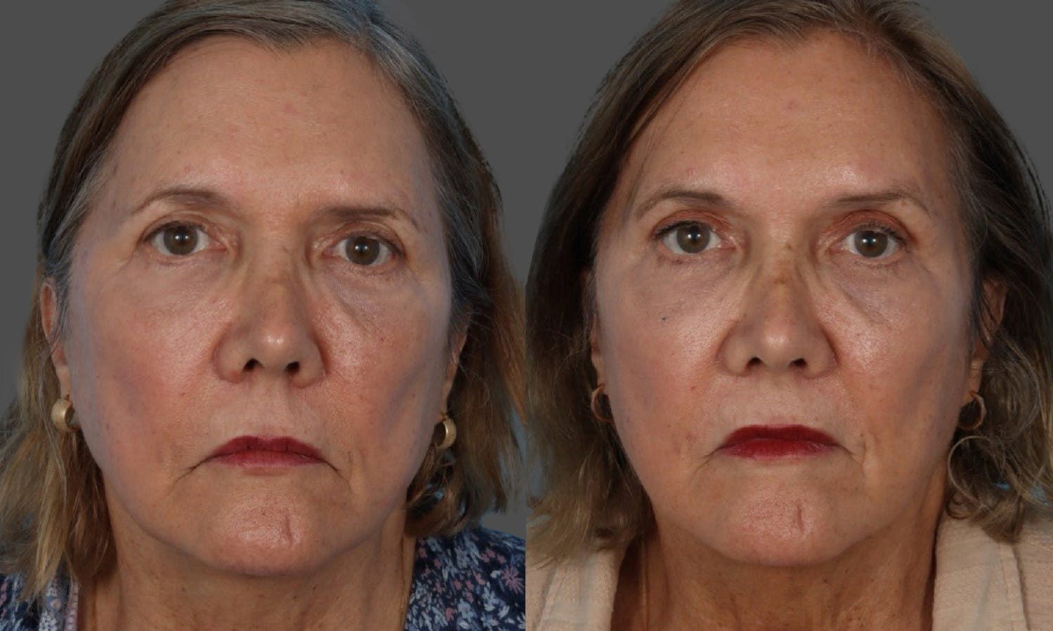 Endoscopic Brow Lift Before & After Gallery - Patient 285771 - Image 1