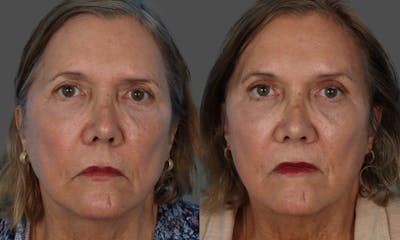 Endoscopic Brow Lift Before & After Gallery - Patient 285771 - Image 1