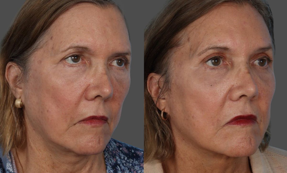 Endoscopic Brow Lift Before & After Gallery - Patient 285771 - Image 2