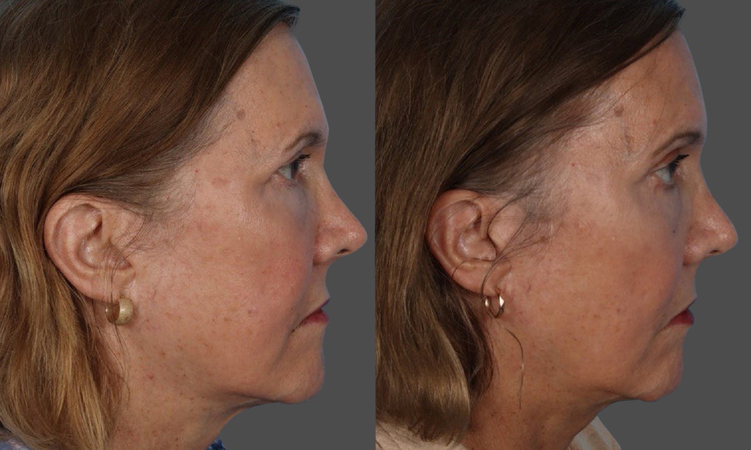 Endoscopic Brow Lift Before & After Gallery - Patient 285771 - Image 3