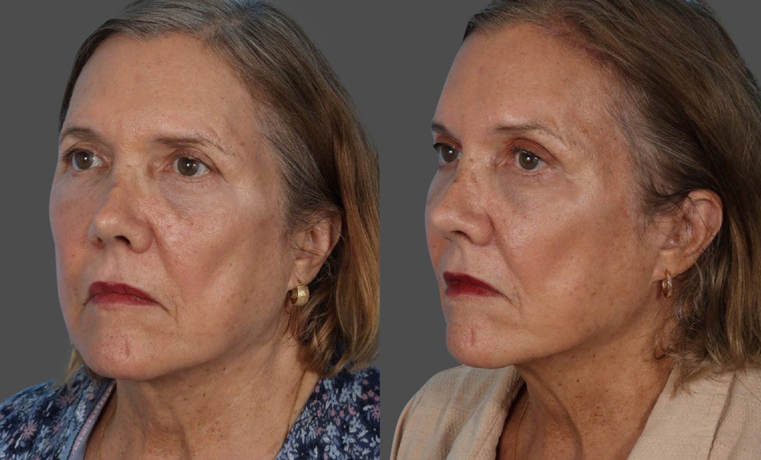 Endoscopic Brow Lift Before & After Gallery - Patient 285771 - Image 4