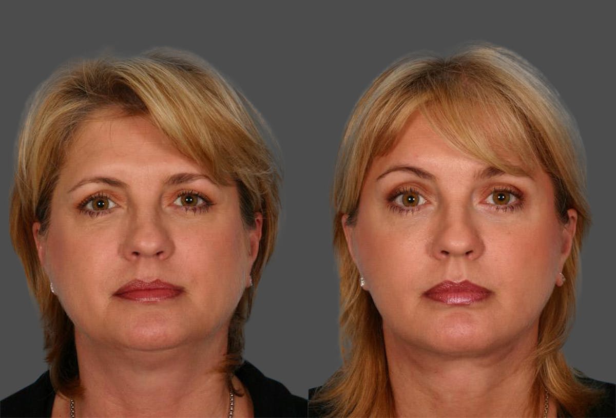 Endoscopic Brow Lift Before & After Gallery - Patient 290149 - Image 1
