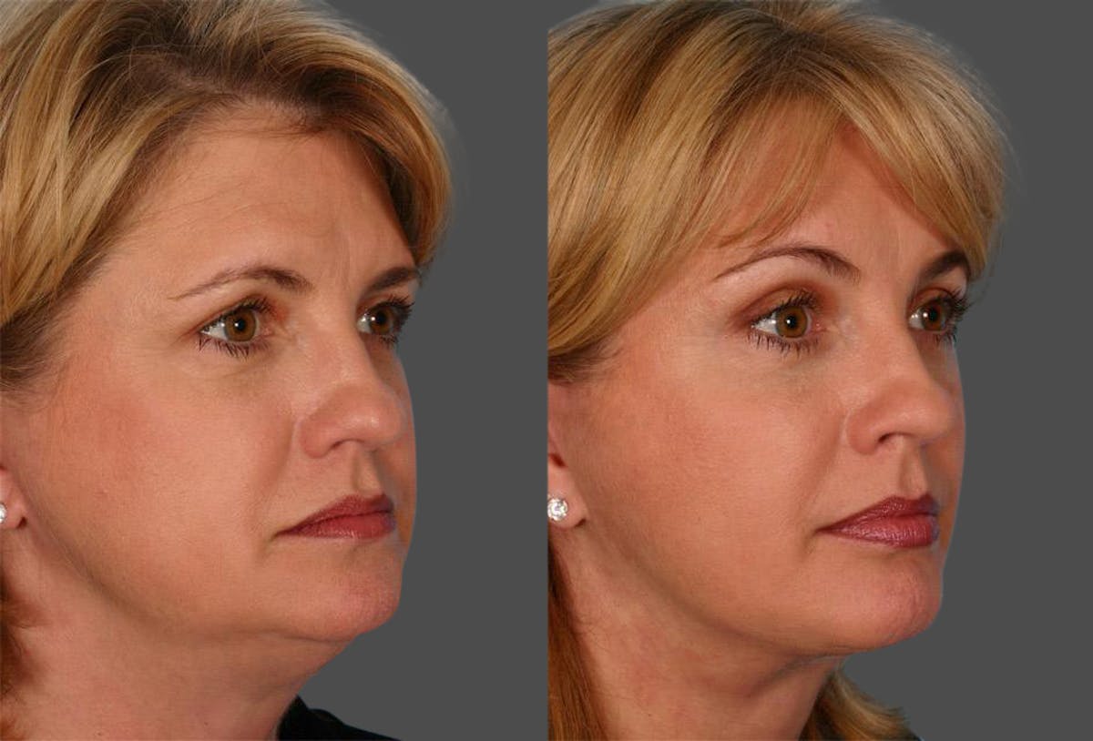 Endoscopic Brow Lift Before & After Gallery - Patient 290149 - Image 2